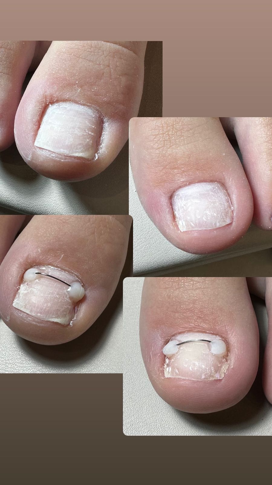 Vier foto's van ingegroeide teennagels en de geplaatste nagelbeugel